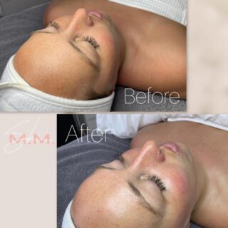 Before and After one “Hydrofacial Plus” ✨ 
Amazing what even one treatment can do. If you are looking for a glow up facial for the holidays this is it! At M.M.Skin we customize all treatments so you are in good hands. 
.
.
.
Book your treatment today! Booking link in Bio 📆
If you have any questions feel free to DM us!