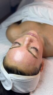 Dermaplaning is a physical exfoliation technique that uses a sterile surgical scalpel to gently remove dead skin cells and fine vellus hair (peach fuzz) from the surface of the skin. This process leaves the skin feeling incredibly smooth and looking brighter by unveiling the fresher, more radiant skin underneath.
.
.
Microneedling also known as collagen induction therapy, involves using a device with tiny needles that create controlled micro-injuries in the skin. These micro-injuries trigger the skin’s natural healing process, stimulating collagen and elastin production, which improves the texture and appearance of the skin.
.
.
Both treatments are effective on their own, but when combined, they can provide enhanced results, particularly for improving skin texture and overall appearance.
#chicagofacials #chicagoskincare #skincare