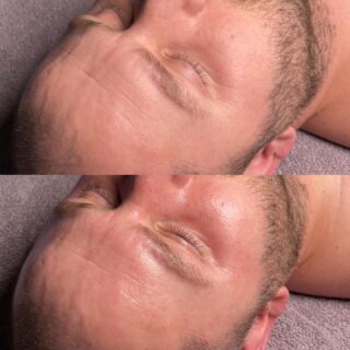 Take a look at this before and after… Need I say more… Look what one Hydrofacial can do for your skin. WOW! 
We did the Hydrofacial Plus and I Added a super light Korean skincare peel. Skin is looking hydrated, plump and look at how all the fine lines and wrinkles softened up 🫶🙌
All treatments are customized for each an every individual skin need. Whether we need to focus on more extractions, hydration, circulation or relaxation. We will customize it just for you. 
#skincare #chicagoskincare #chicagoesthetician #buccalmassage #chicagofacials #youresthetician