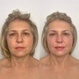 Before & After ✨ Buccal Massage Magic ✨

One of my proudest moments in my esthetic career—these incredible results were achieved in just ONE session using the @helenapahavamethod Buccal Massage! 💆🏽‍♀️✨

This technique works inside & out to sculpt, lift, and release tension, giving your skin a naturally youthful, radiant glow. Imagine what consistent treatments could do for your skin! 👏🏽

Ready to experience these results for yourself? Book your session today!

📍 Booking Link in Bio
#BuccalMassage #NaturalLift #MMSkin #SculptedGlow #FacialMassage”