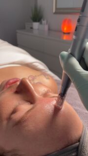 ✨ The Power of Microneedling ✨

Looking for smoother, firmer, and more radiant skin? Microneedling is your go-to treatment for boosting collagen and revealing a healthier, youthful glow! 💉✨

🔹 What is Microneedling?
This treatment uses tiny, controlled micro-injuries to stimulate your skin’s natural healing process, resulting in:

✔️ Improved texture & tone
✔️ Reduced fine lines & wrinkles
✔️ Faded acne scars & pigmentation
✔️ Boosted collagen for plumper skin
✔️ Minimized pores

It’s the ultimate skin reset for a radiant, refreshed complexion. Consistency is key for optimal results—are you ready to glow? 💫

📍 Book your microneedling session today!
#MicroneedlingResults #CollagenBoost #MMSkin #HealthySkinJourney #GlowingComplexion”