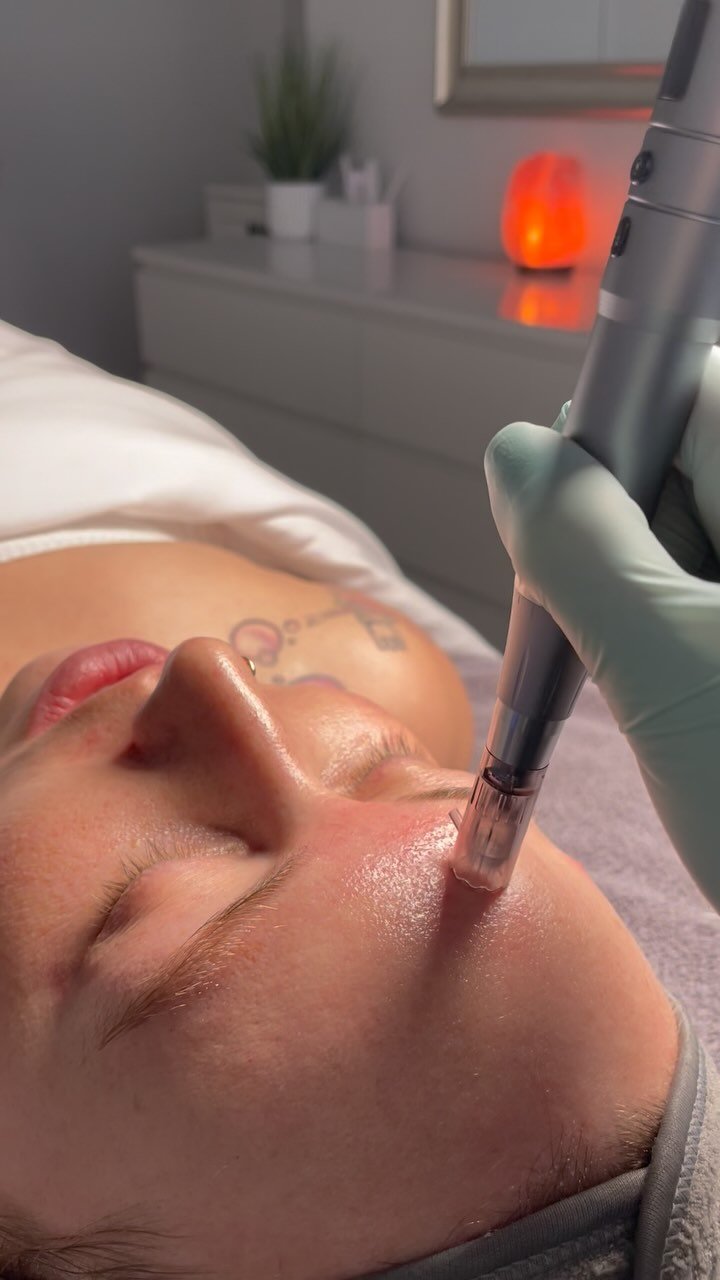 ✨ The Power of Microneedling ✨
Looking for smoother, firmer, and more radiant skin? Microneedling is your go-to treatment for boosting collagen and revealing a healthier, youthful glow! 💉✨
🔹 What is Microneedling?
This treatment uses tiny, controlled micro-injuries to stimulate your skin’s natural healing process, resulting in:
✔️ Improved texture & tone
✔️ Reduced fine lines & wrinkles
✔️ Faded acne scars & pigmentation
✔️ Boosted collagen for plumper skin
✔️ Minimized pores
It’s the ultimate skin reset for a radiant, refreshed complexion. Consistency is key for optimal results—are you ready to glow? 💫
📍 Book your microneedling session today!
#MicroneedlingResults #CollagenBoost #MMSkin #HealthySkinJourney #GlowingComplexion”