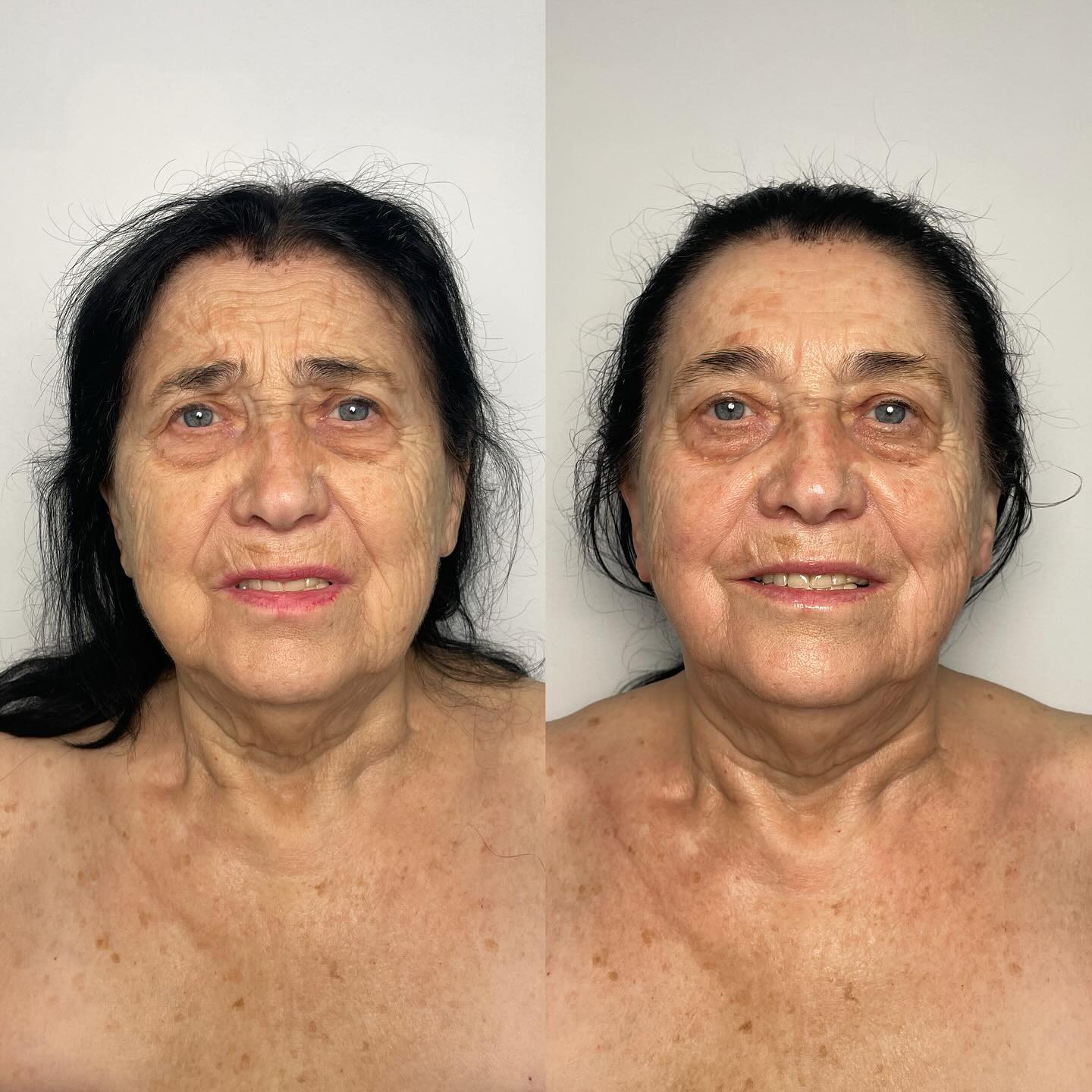 “It’s just a massage” they say. But I say screw those nay sayers. This is a Before and After just one session of Sculptural lifting face massage with buccal massage by Yakov Gerashkovic method performed by yours truly, Me. Just like you need consistency with literally ANYTHING(gym, healthy eating, skincare,Botox ,filler etc.) this treatment requires consistency as well. If this is the before, and after just one session, imagine what transformation consistent treatments would bring.
#buccalmassage #hinsdale #hinsdalebuccalmassage #chicagobuccalmassage