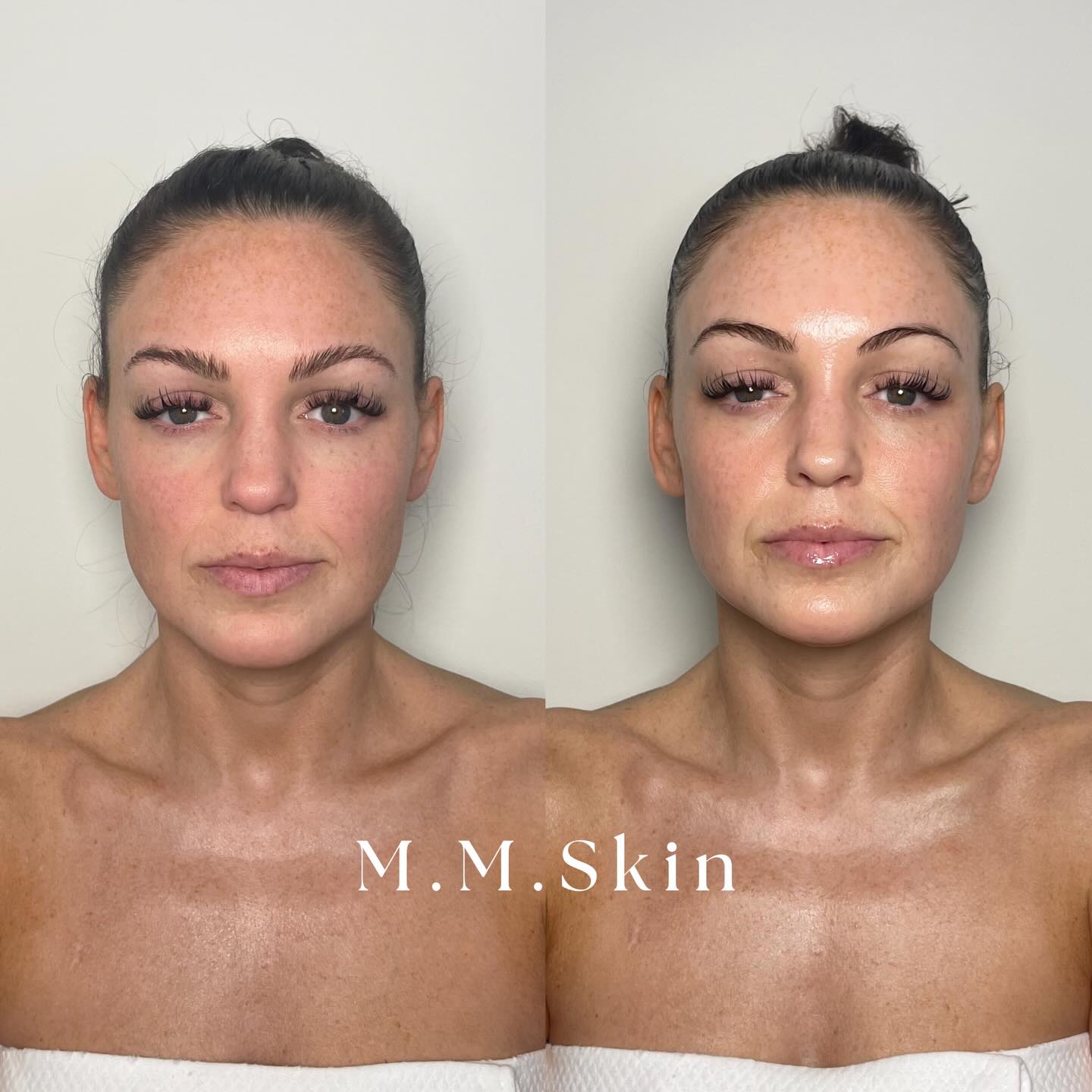 The before(left) and After(right) speak for themselves!
Buccal Massage - Sculptural face lifting technique ✨
Just one session can help:
• Release deep tension in the jaw + facial muscles
• Reduce puffiness and fluid retention
• Lift + define
• Soften the overall expression
• Enhance circulation for a natural, healthy glow
These results come from working not only on the face, but also the chest, neck, and scalp — allowing the entire system to relax and drain properly.
Natural. Sculpted. Restored. 🤍
📍 M.M.Skin | Hinsdale
#BuccalMassage #SculptingFacial #FacialMassage #NaturalFacelift #JawTensionRelief #GlowingSkin #FacialContouring #LymphaticFacial #TMJRelief #SkinHealthMatters #MMSkin #AdvancedAesthetics #HinsdaleIL #OakBrookIL #ChicagoSuburbs #SelfCareRoutine